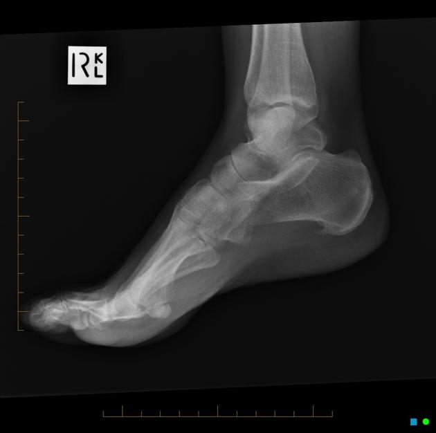 Medial Malleolus Bone Spur Anterior Ankle Impingement Dynamic Physio Therapy Naples Fl